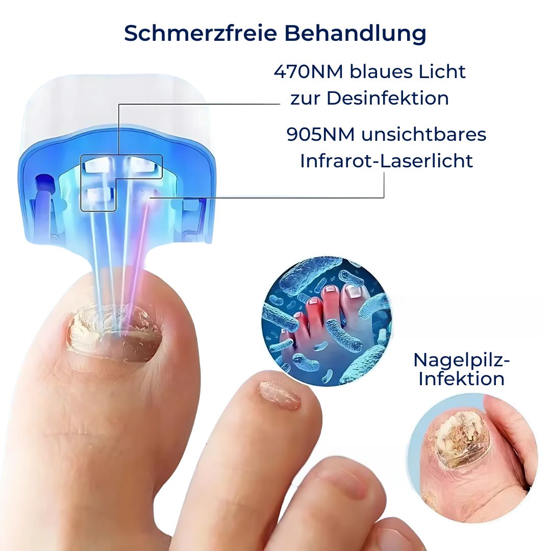 Laser-Nagelpilz-Gerät - Schmerzfrei und wirksam
