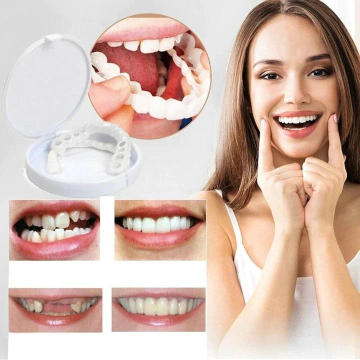 Snap-on Veneers – Sofortige Lächelnkorrektur gegen ästhetische Makel