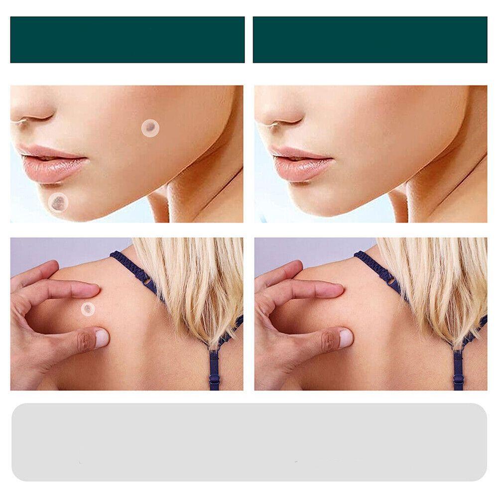 SkinClear Pflaster zur Entfernung von Hautanhängseln und Warzen | Hydrokolloid-Technologie | Schmerzfrei und diskret | Für alle Hauttypen | 120 Stück